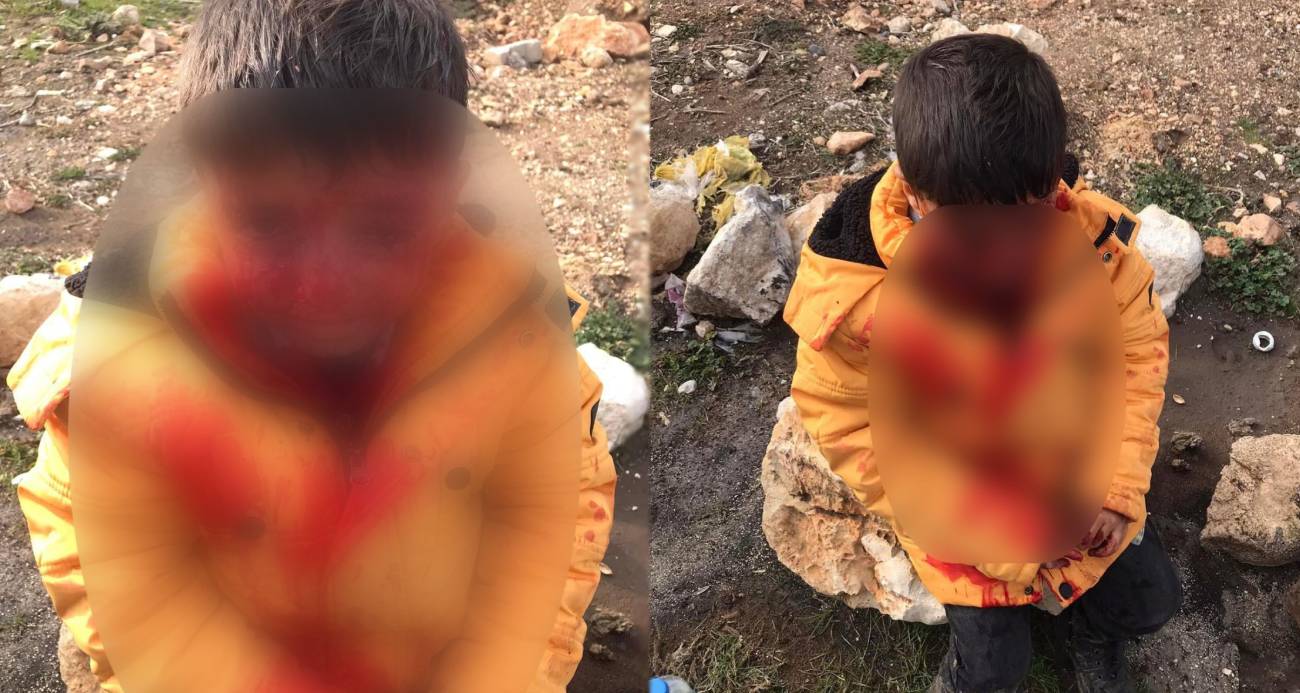 Başıboş köpekler dehşet saçtı: Saldırıya uğrayan çocuk ağır yaralandı