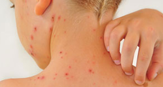 Ebeveynler kızamık vakalarına dikkat!