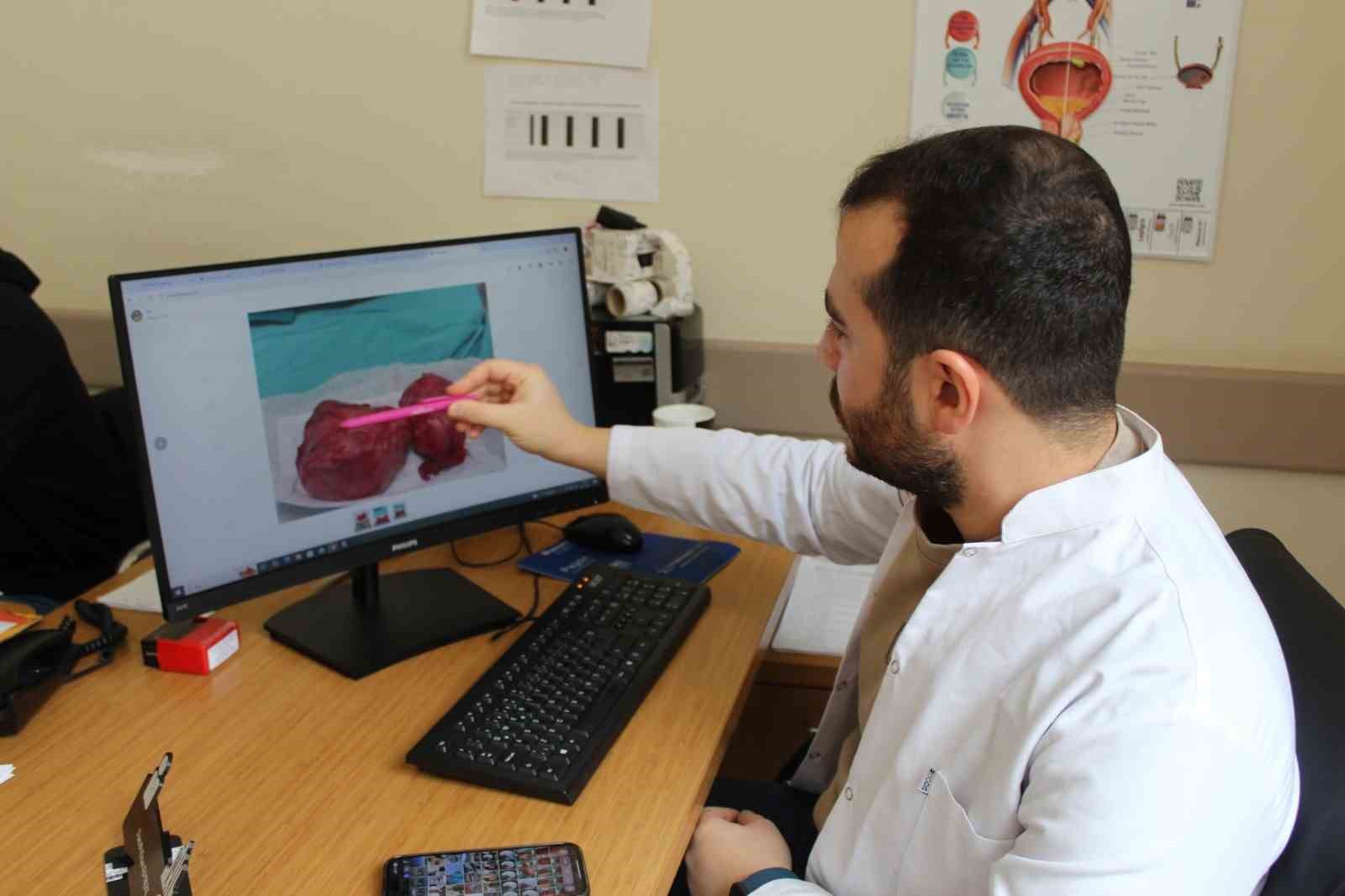 Tatvan Devlet Hastanesinde, 300 gramlık prostat dokusu başarıyla çıkarıldı