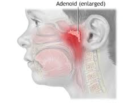 “Geniz eti ve bademcik hastalıkları işitme kaybına yol açabilir”