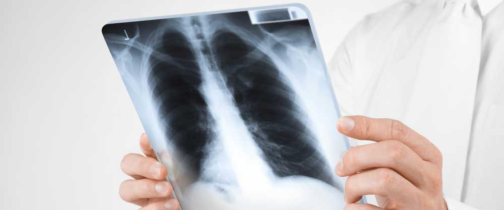 Gürpınar İlçe Sağlık Müdürlüğü’nden Verem Hakkında uyarılar