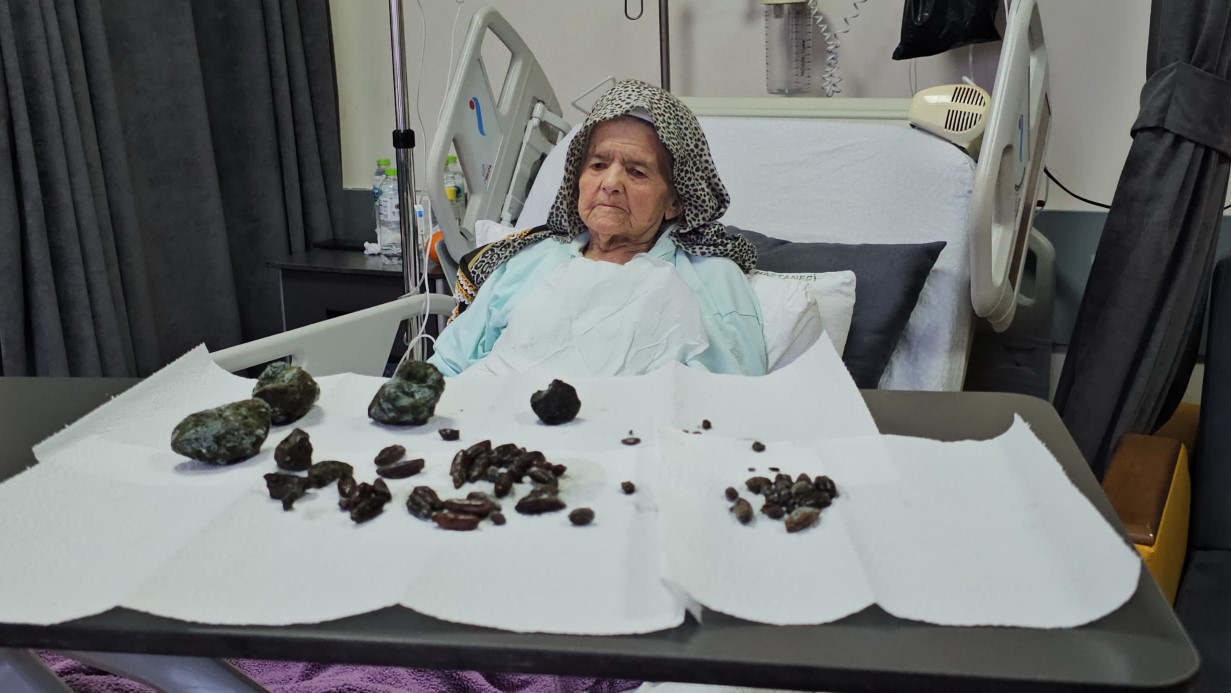 92 yaşındaki kadının midesinden ve bağırsaklarından çıkanlar şok etti!