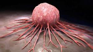 Türkiye’de 100 bin kişiden 200’ü kanser