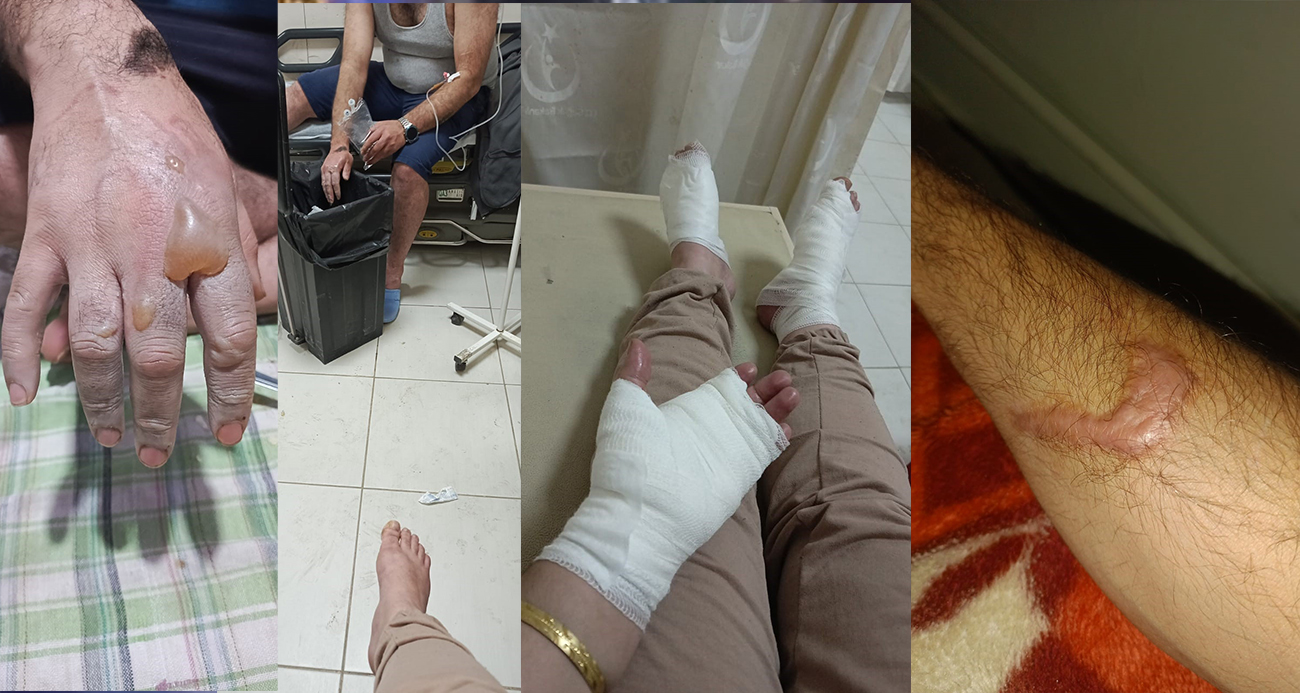 Lavabo açıcı patladı: İki kardeşin vücudunda yanıklar oluştu