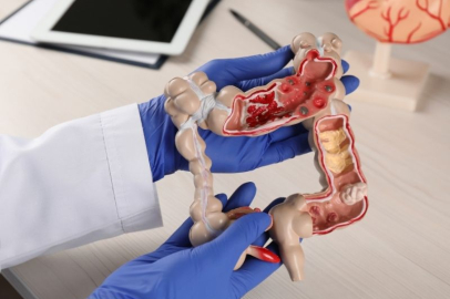 Erken teşhisle kolon kanseri önlenebilir