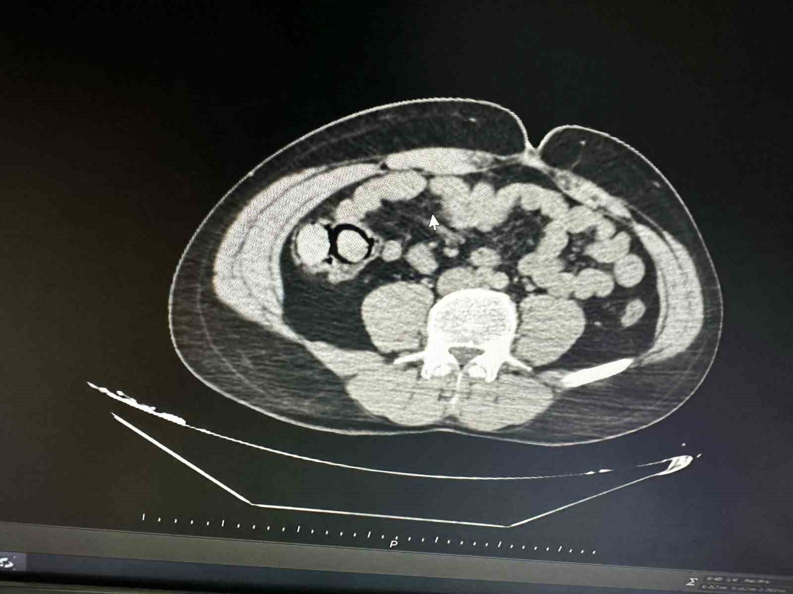 Midelerinden 10 parça halinde uyuşturucu çıktı