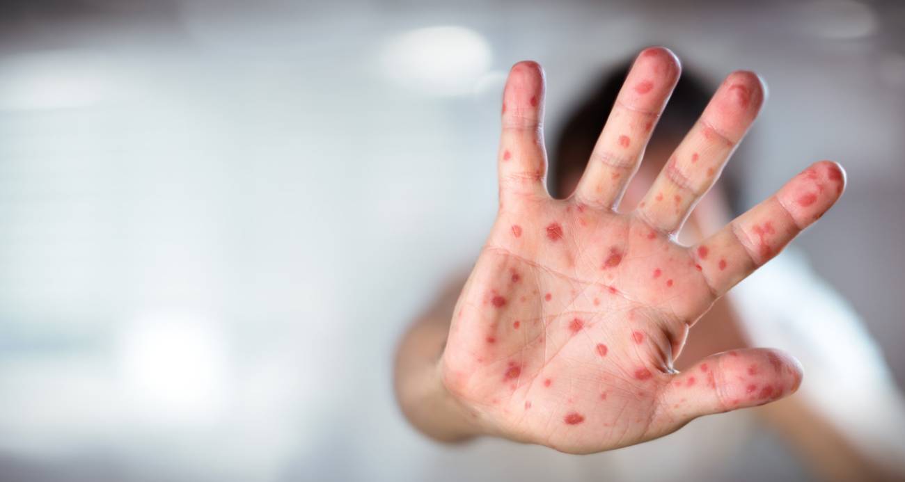 ABD’de kızamık salgınından ölen çocuk sayısı 2’ye yükseldi