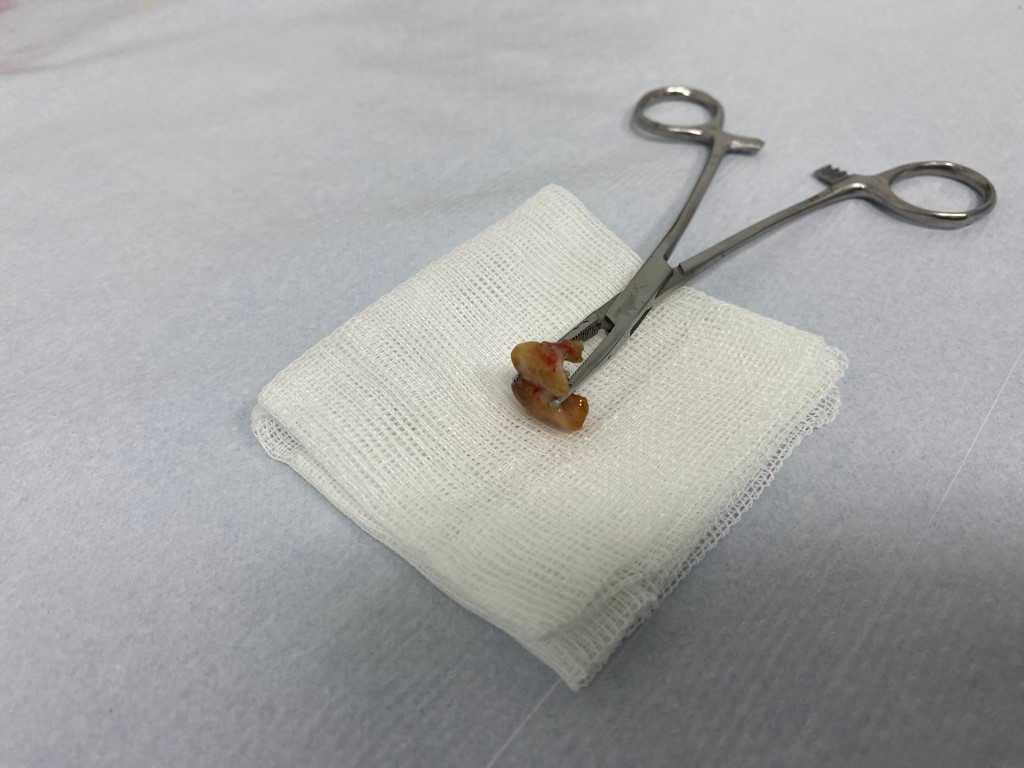 Uykusunda yuttuğu dişler bronşundan çıkarıldı