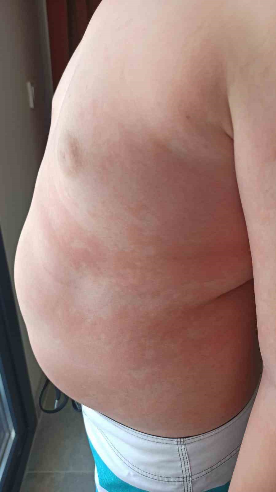 Çocuklarda besin alerjilerine dikkat: “Yiyeceklerin içeriği sorgulanmalı, anafilaksi hayatı tehdit edebilir”