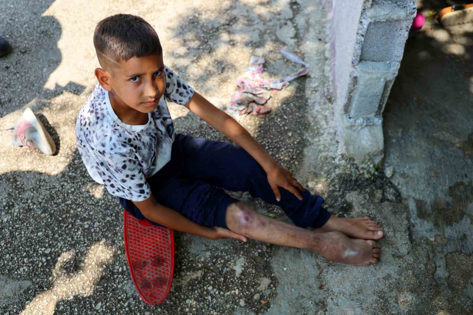 Kaza sonrası ayağı yanlış kaynadı, tekerlekli sandalyesi olmadığı için hayatı kaykay üzerinde geçiyor