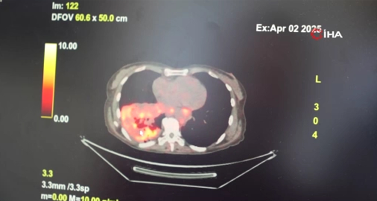 Sigara Kullanmayan Bireylerde “Kanser” Riski Artmaya Başladı
