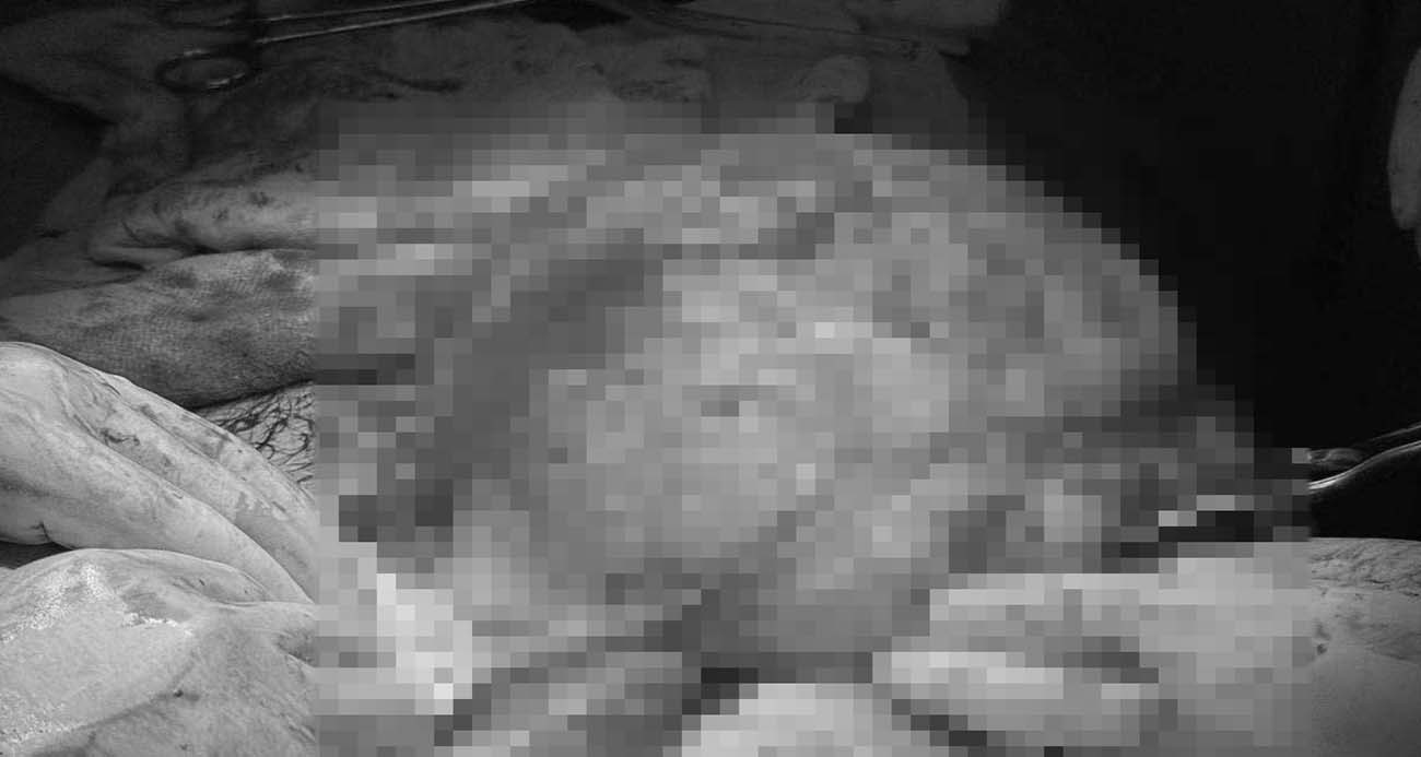 Karın Ağrısı Sandı, 30 Santimlik Kitle Çıktı