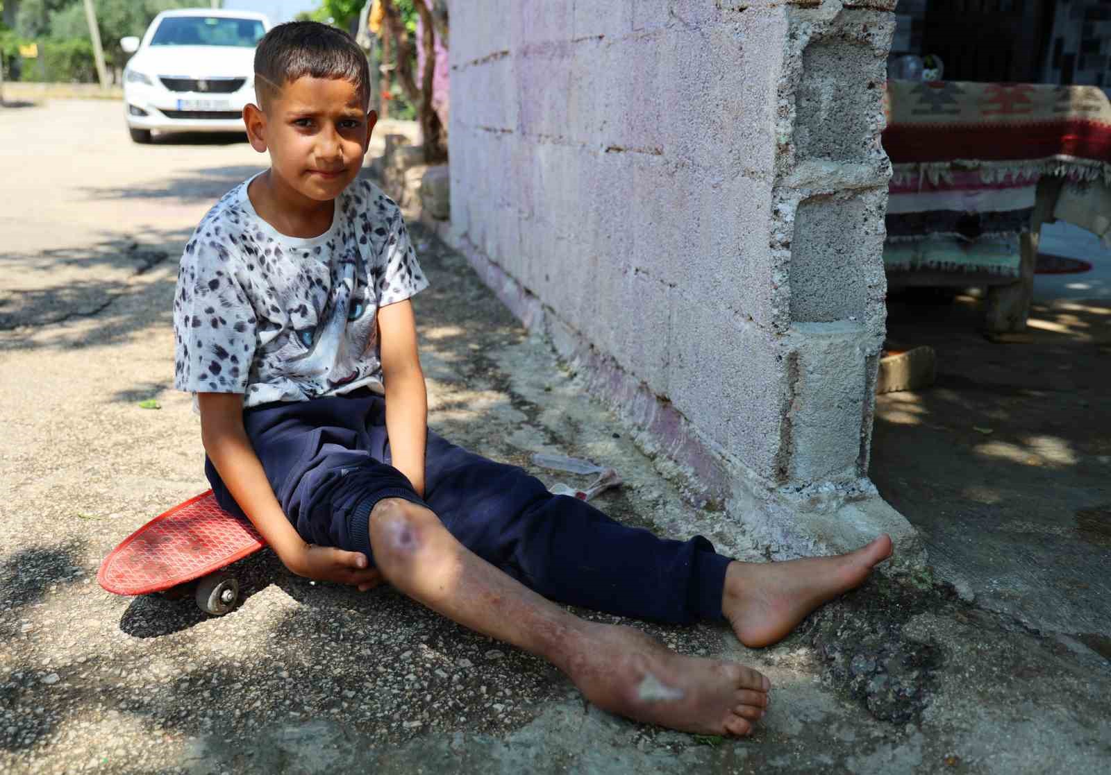 Kaza sonrası ayağı yanlış kaynadı, hayatı kaykay üzerinde geçiyor