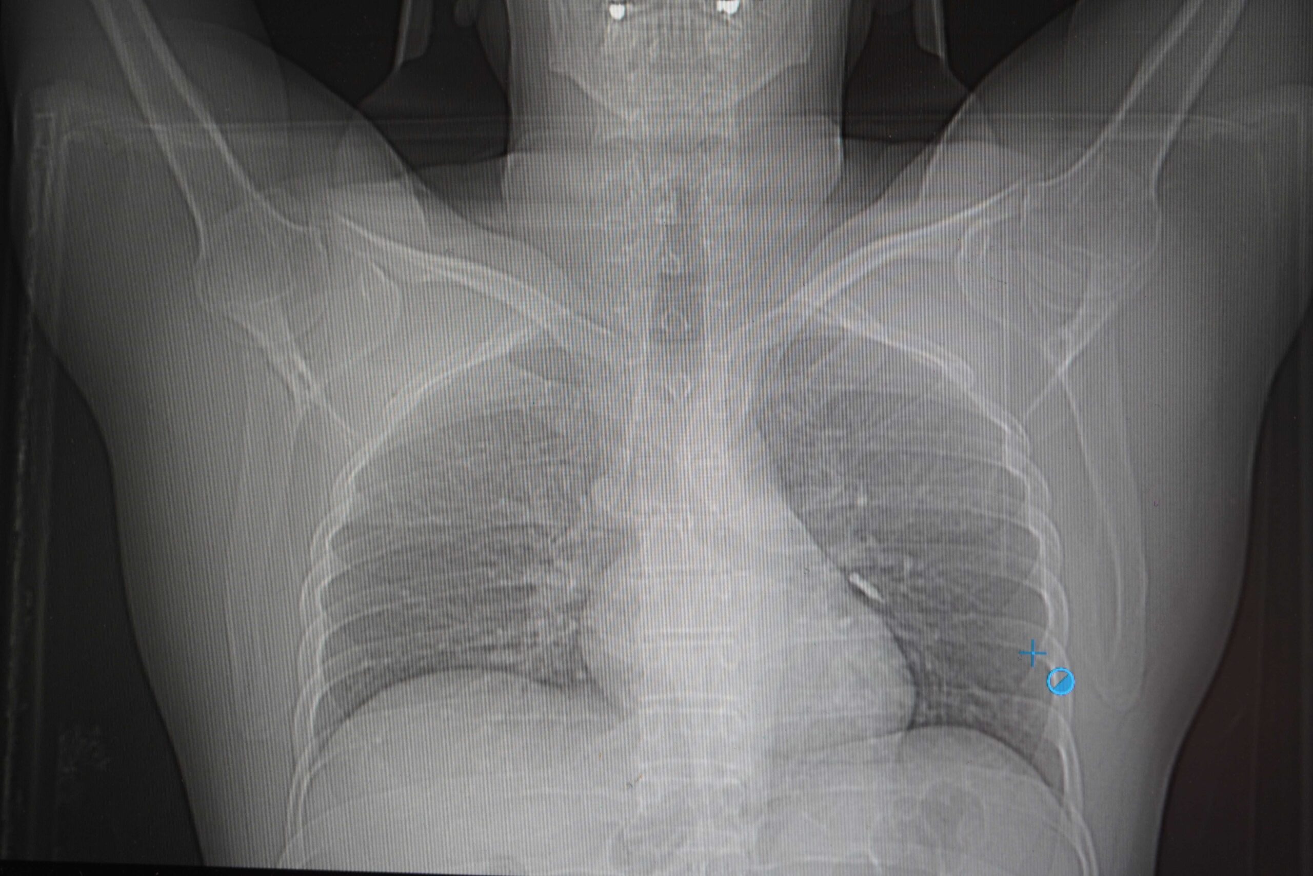 Van’da Diş Tedavisinde Korku Dolu Anlar: İmplant Vidası Soluk Borusuna Kaçtı!