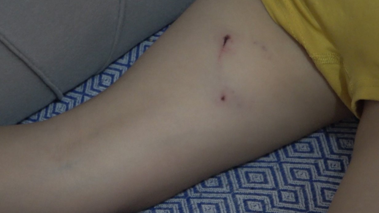 Rize’de 5 yaşındaki çocuğa sokak köpeği saldırdı