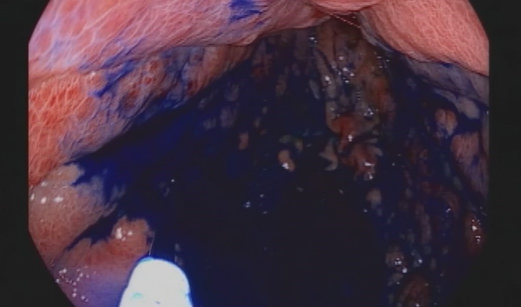 Boyama Tekniği ile Kanserli Hücreler Daha Kolay Tespit Ediliyor