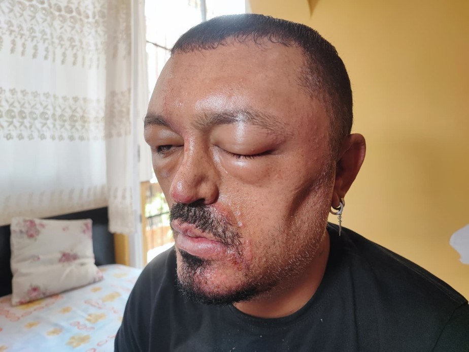 Saçlarını siyahlatmak için aldığı şampuan hayatını kabusa çevirdi