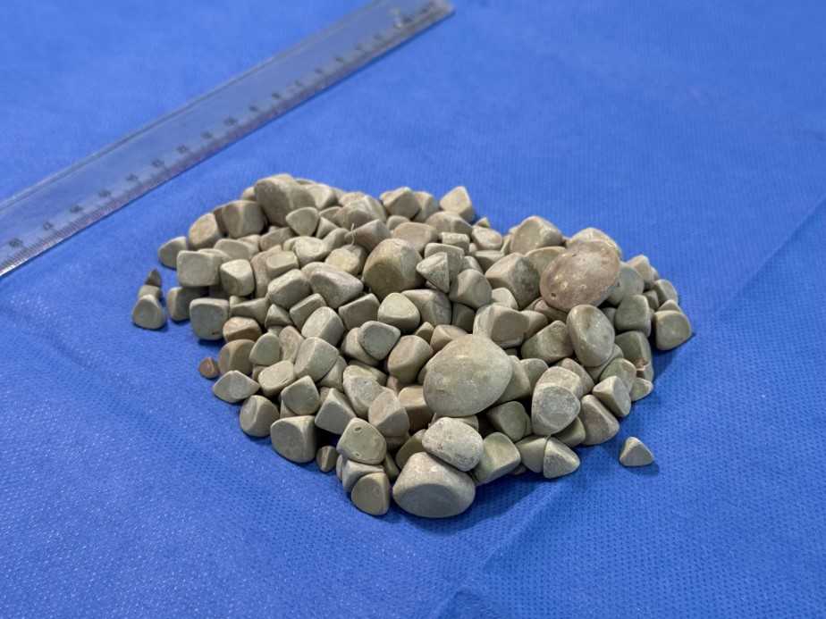 Vücudundan 287 tane taş çıkarıldı, doktorlar bile şok oldu