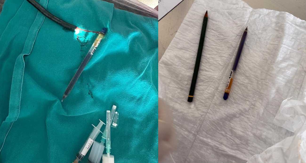 Genç kadının midesinden iki kalem çıkarıldı