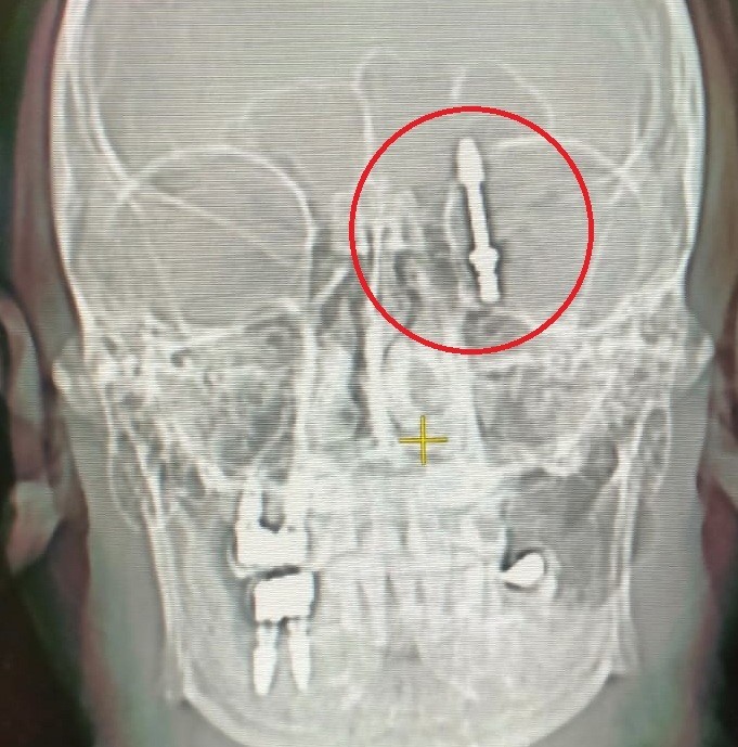 Beynine saplanan implant hayatını kararttı: 2 yıldır adalet bekliyor