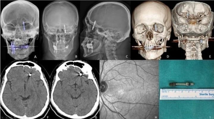 Beynine saplanan implant hayatını kararttı