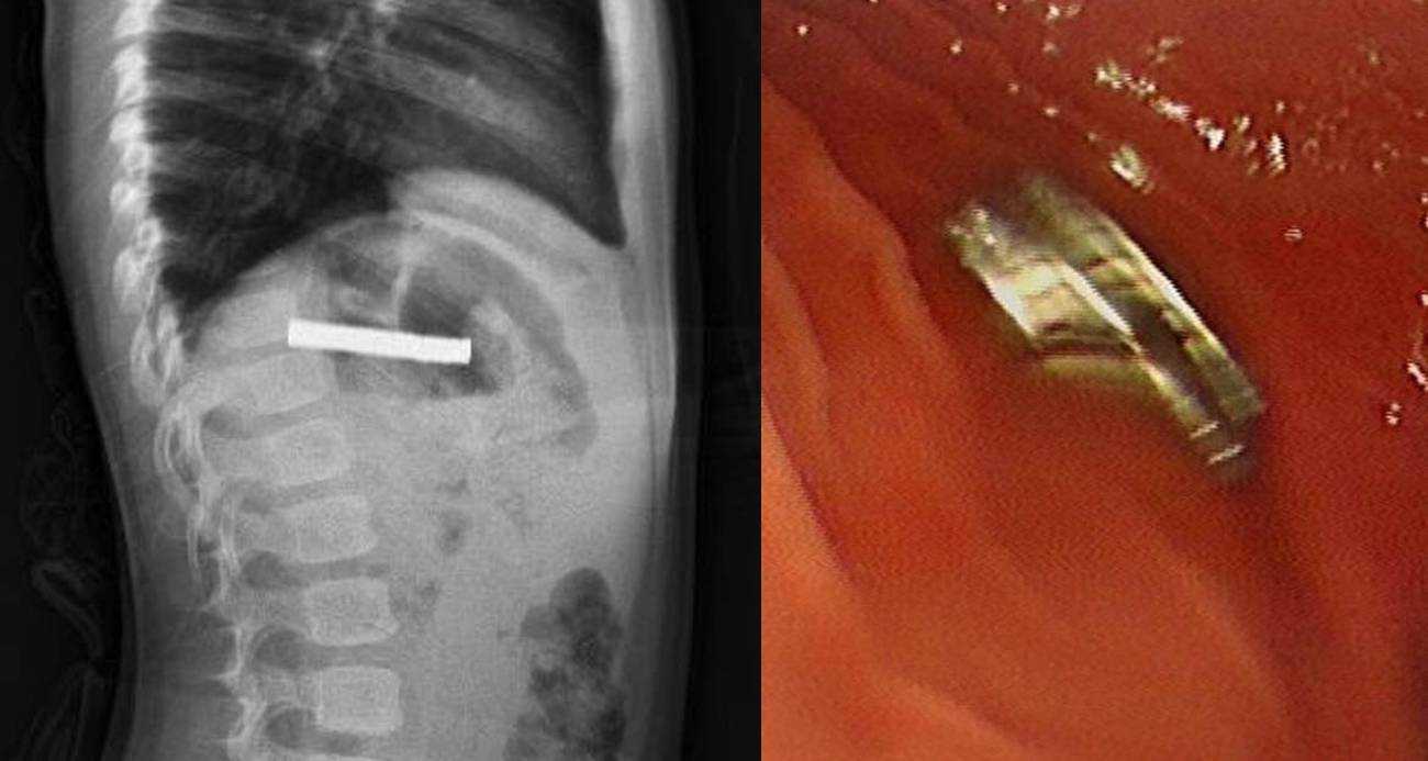 Çocuğun boğazından 19 adet mıknatıs çıkartıldı
