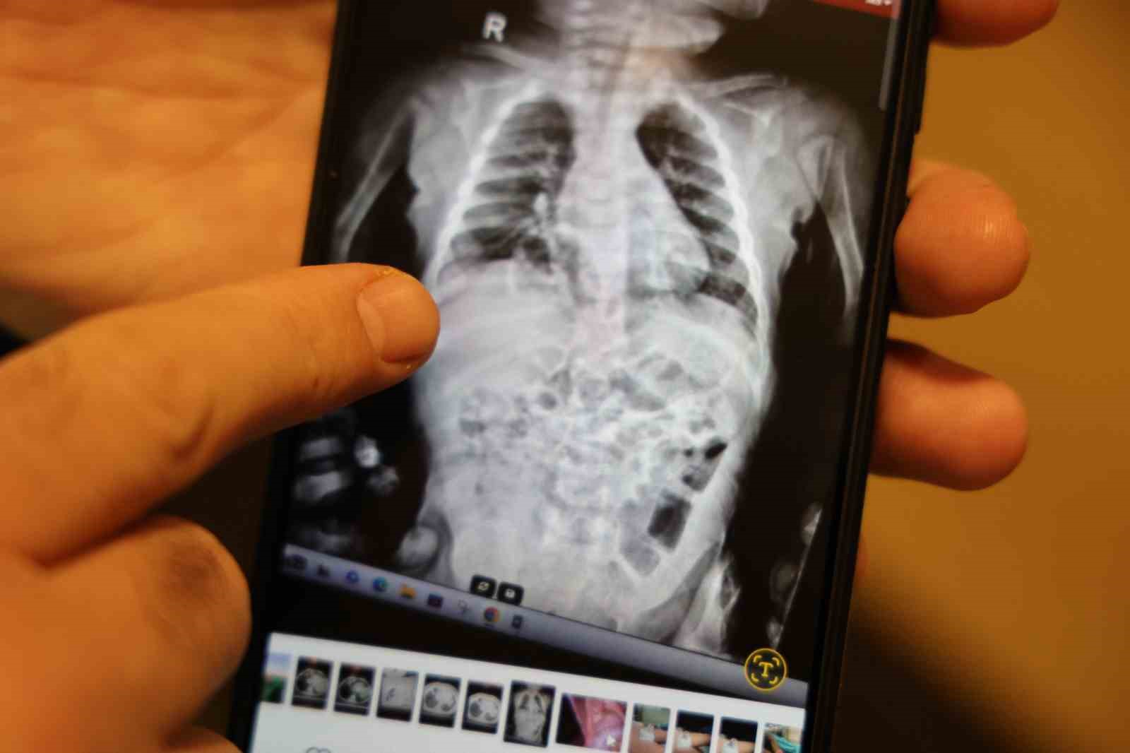 200 binde bir görülen hastalıkla 2 yıl boyunca yaşayan çocuk sağlığına kavuştu