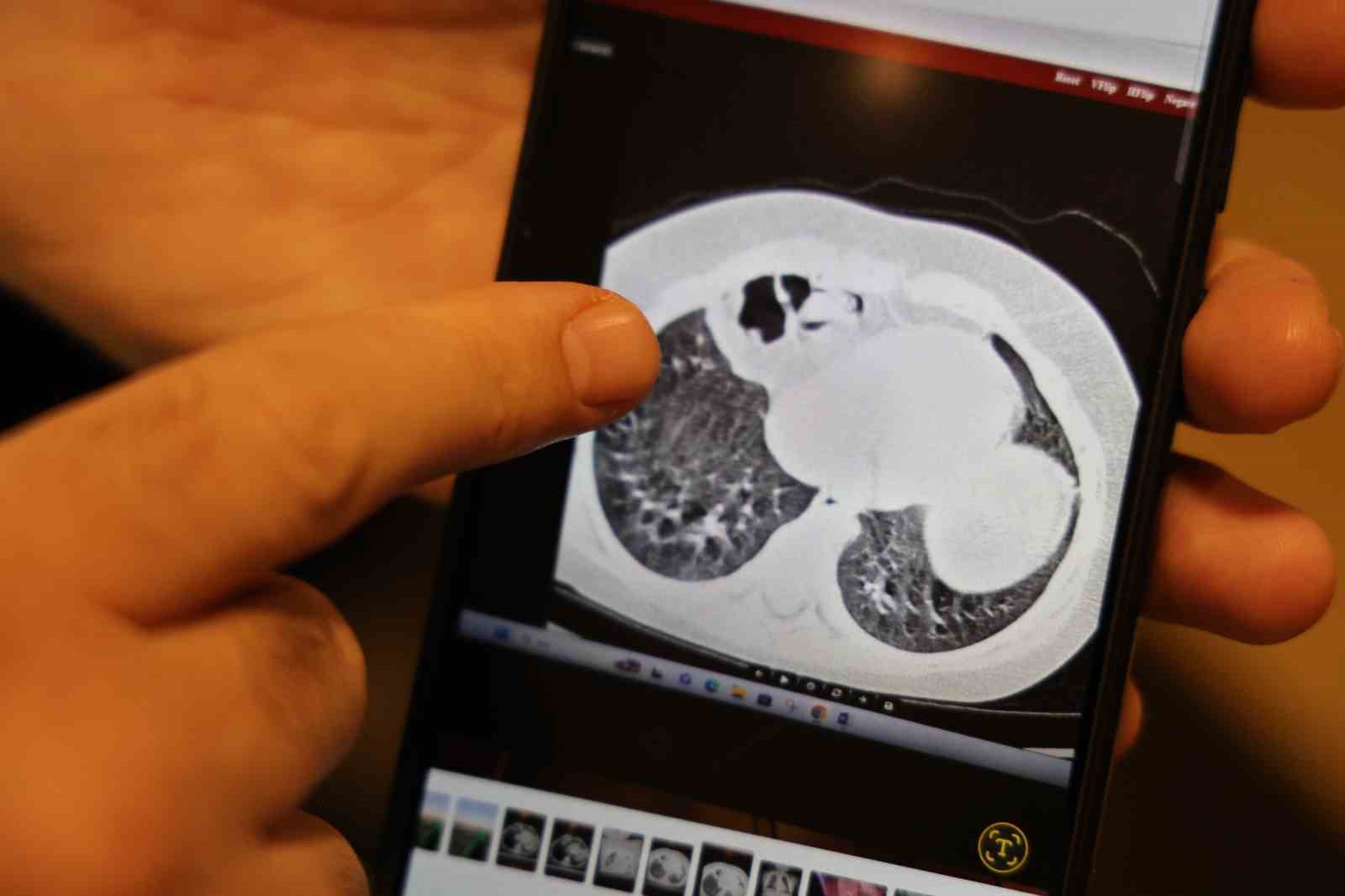 200 binde bir görülen hastalıkla 2 yıl boyunca yaşayan çocuk sağlığına kavuştu